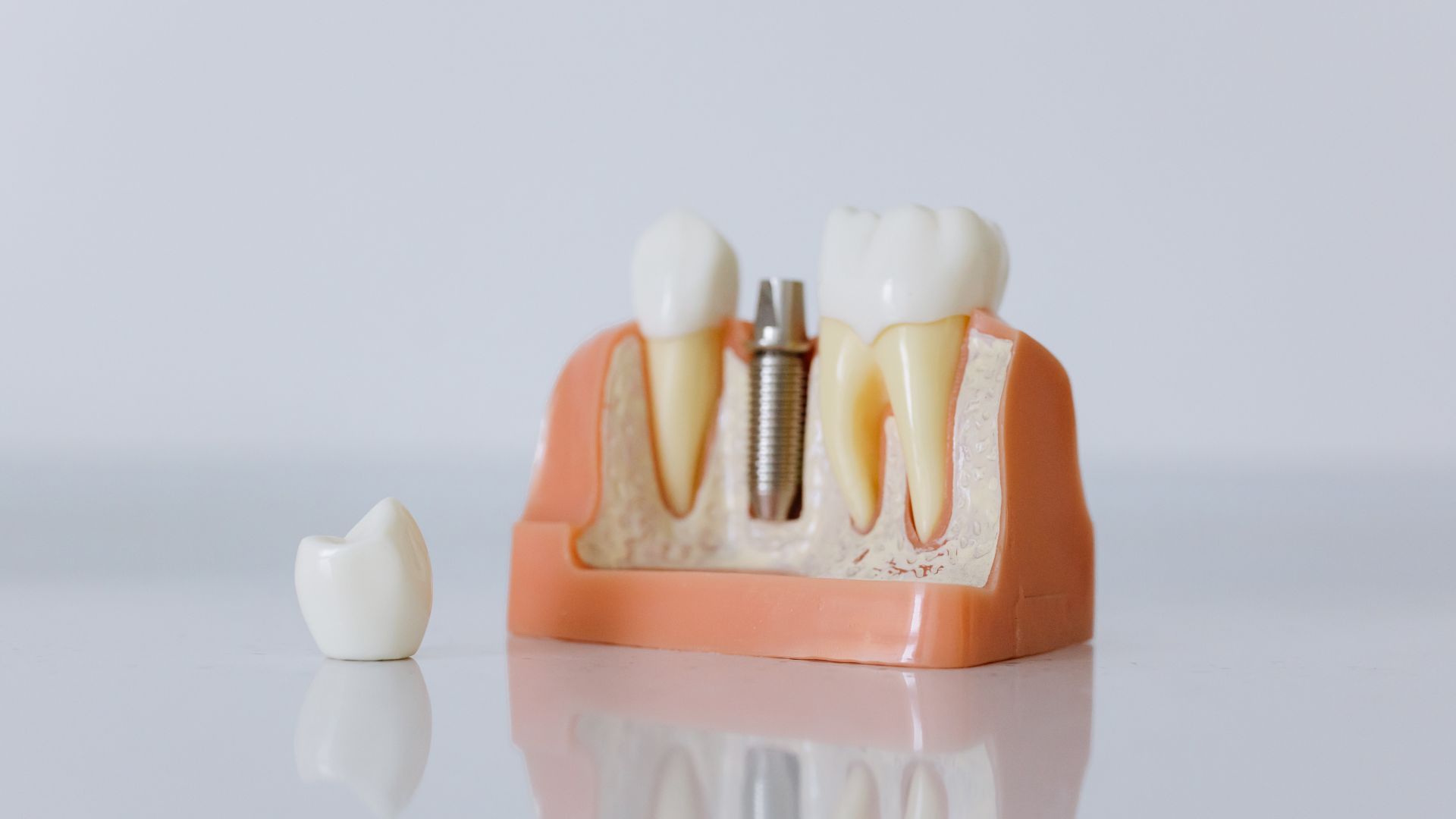 IMPLANTES DENTALES